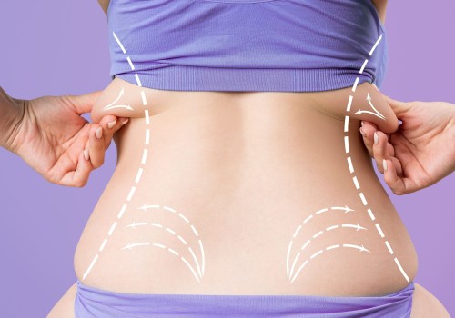 Can fat return to the same area after liposuction?