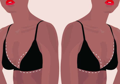Breast Liposuction: How Many Cup Sizes Can You Go Down?
