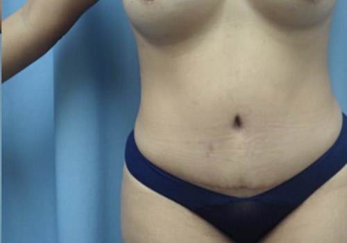 The Truth About Weight Gain After Liposuction