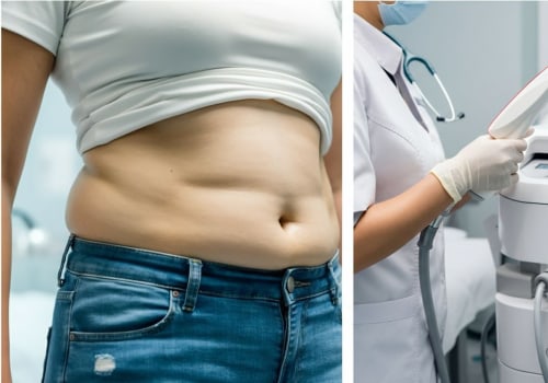 Body Sculpting in 2026: Why Liposuction Is Becoming More Precise and Natural