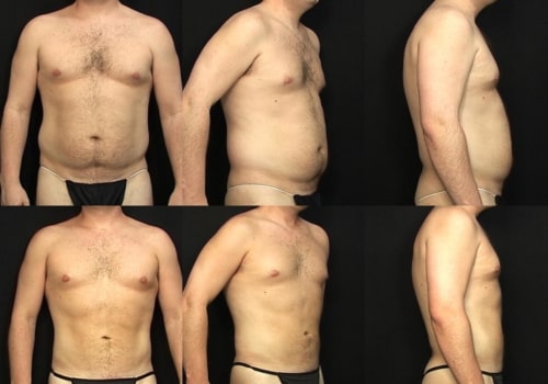 The Truth About Liposuction on the Belly